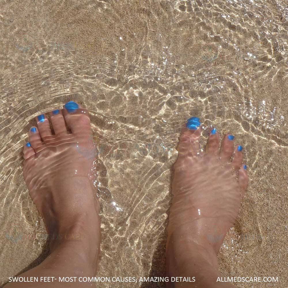 Swollen Feet- Most Common Causes, Amazing Details