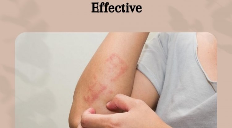 Doctor-Approved Supplements for Lichen Pl****—Safe, Natural, and Effective - Dubai Entertainment