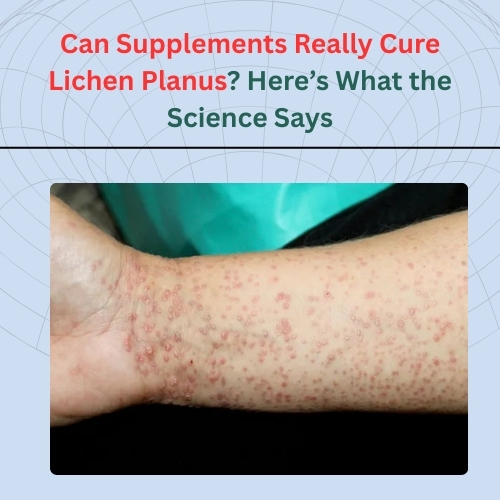 Can Supplements Really Cure Lichen Pl****? Here’s What the Science Says - Herbs Solutions By Nature Blog