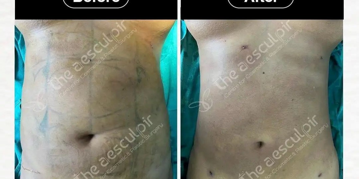 Get the Perfect Contours with Liposuction Surgery in India at Theaesculpir