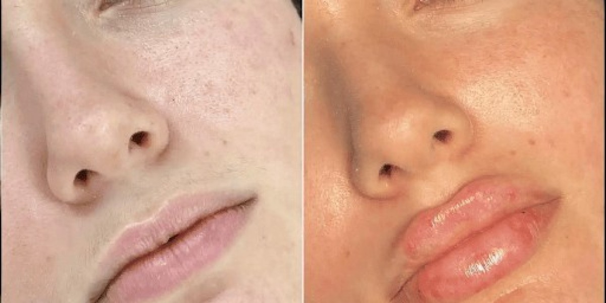 Best Doctors in Dubai for Fillers: Secrets to Youthful Skin
