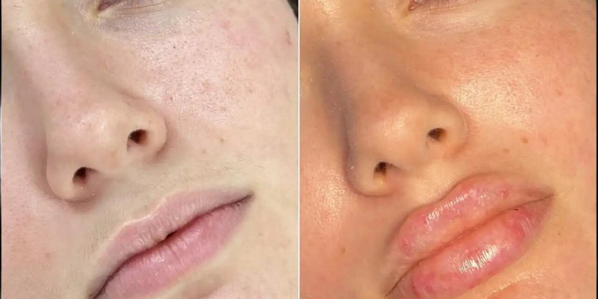 The Secrets to Perfect Fillers Treatment in Dubai