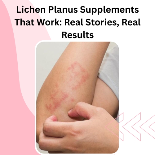 Lichen Pl**** Supplements That Work: Real Stories, Real Results - Herbal Care Products - Blog
