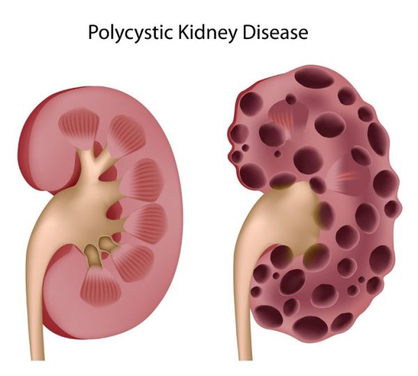 What Natural Treatments for Reversing Polycystic Kidney Disease - Herbal Care Products - Blog